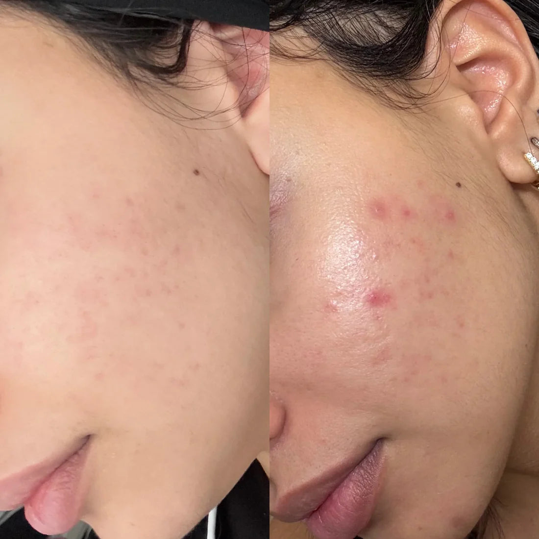 DEAR DERM - NIACINAMIDE AMPOULE SERUM